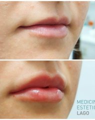 Reafirmación y volumen de labios