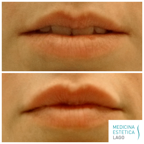 Antes/después Aumento de labios